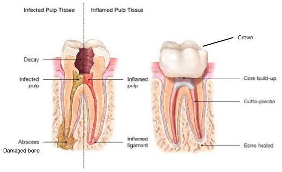 root canal treatment2